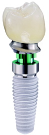 C04_IMPLANT_TOOTH