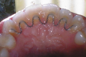 Upper retainer